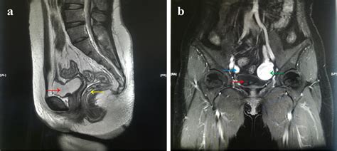 Rare Case Of Bizarre Leiomyoma In Mayer Rokitansky Küster Hauser Syndrome