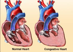 Symptoms of heart failure (at rest or during exercise). Congestive Heart Failure | Brookhaven Heart Specialists