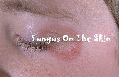 Fungus On The Skin