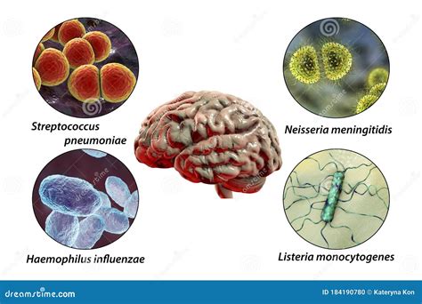 Etiología De La Meningitis Bacteriana Stock De Ilustración