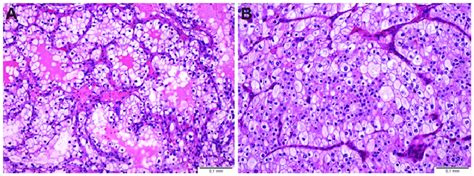 Representative Histological Images Of Renal Cell Carcinoma A Clear