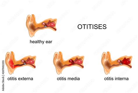 Ear Otitis Media Internal External Stock Vector Adobe Stock