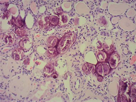 Urinary Schistosomiasis A Case Of Late Presentation Bmj Case Reports