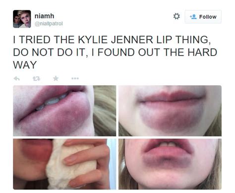 Sucking On A Bottle Lid For Bigger Lips Is A Truly Terrible Idea