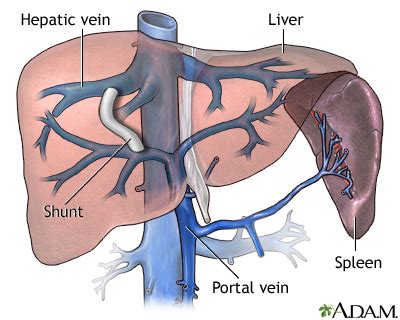 Liver shunts in dogs (portosystemic shunts) usually occur at birth, but they can appear later in life. Transjugular intrahepatic portosystemic shunt (TIPS)