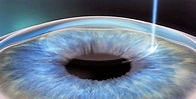 Refractive Surgery | Mitchell Eye Center – Eyeglasses – Eye Care ...