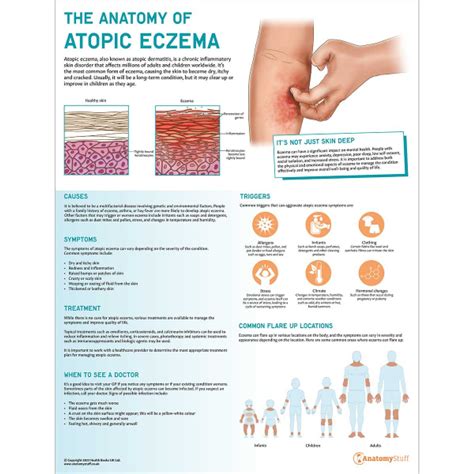 The Anatomy Of Atopic Eczema Chartposter Laminated Dermatology
