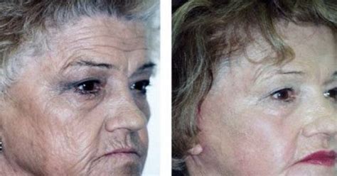 Forget About Botox This Mask Removes Wrinkles After Second Use