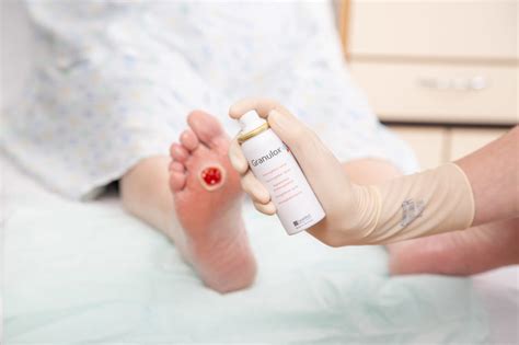 Thousands Of Diabetic Foot Ulcer Patients Could Benefit From Topical
