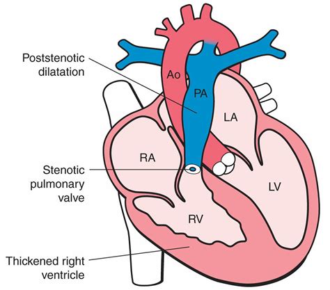Pulmonary Atresia Causes Types Symptoms Diagnosis And Treatment
