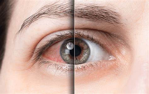 Conjuntivite o que é tipos sintomas e tratamentos Olhar Prime