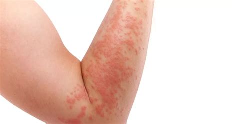 Four Covid Symptoms On Your Skin That May Be The Only Sign Of
