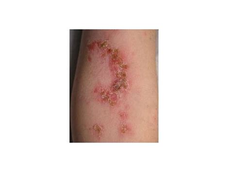 Common Rashes Not To Miss