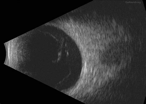 Progression Of Proliferative Diabetic Retinopathy During Pregnancy