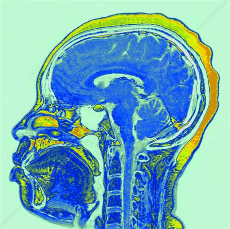 Normal Brain Mri Stock Image C0294665 Science Photo Library