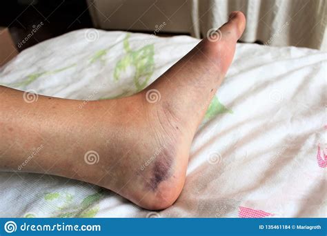 A Blue And Swollen Foot With Ankle Fracture Stock Photo Image Of Fall