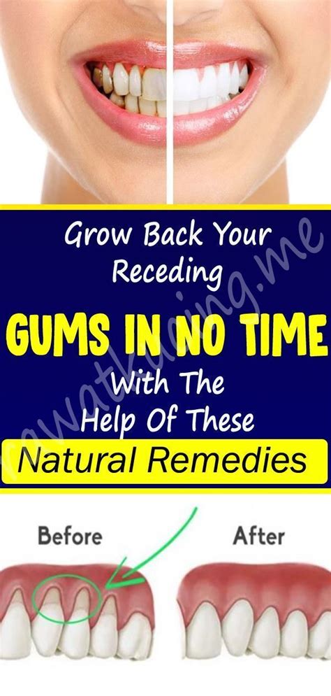 Grow Back Your Receding Gums With The Help Of These Natural Remedies