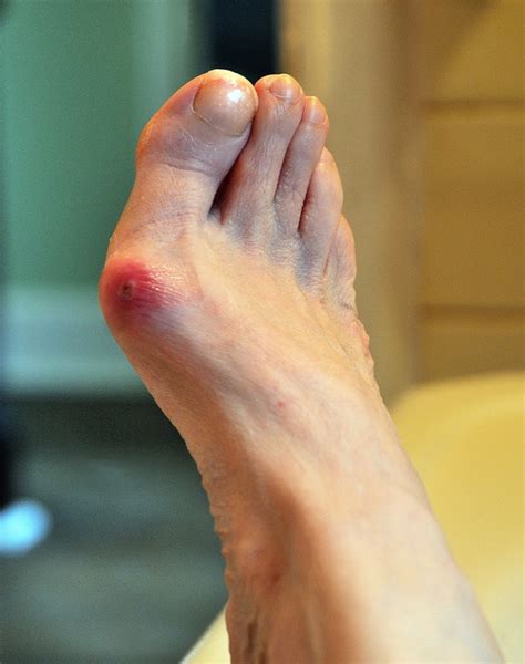 What To Know About Bunions Crimson Foot Care