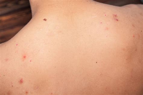 Acne Back Scar Pimple Stock Photos Pictures And Royalty Free Images Istock