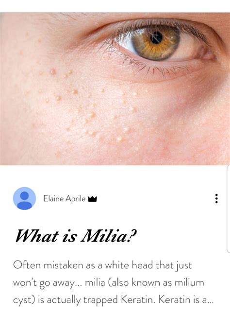 How To Remove Milia Whiteheads Howotremvo