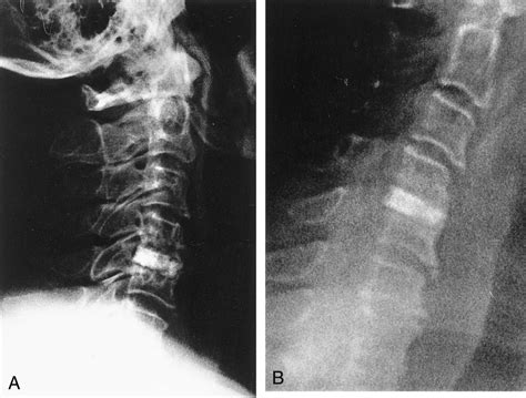 Cervical Disc Herniation In A 71 Year Old Man Who Experienced No