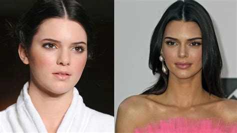 Kendall Jenner El Antes Y El Después De Los Retoques Estéticos De Las Celebrities