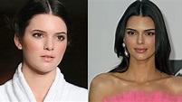 Kendall Jenner | El antes y el después de los retoques estéticos de las ...