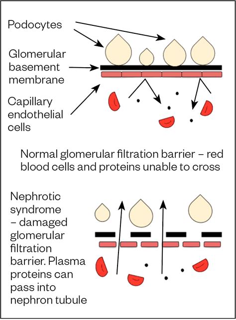 Nephrotic Syndrome In Adults Symptoms And Management The