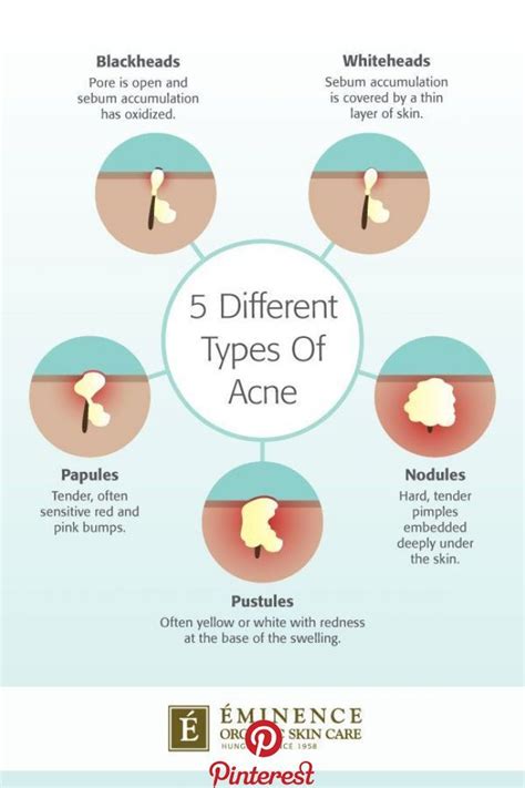 Types Of Acne The Differences Between Your Bumps And Blemishes Types