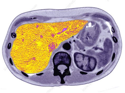 Human Liver Stock Image C0271035 Science Photo Library