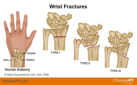 Guide Physiotherapy Guide For Wrist Fracture 2023