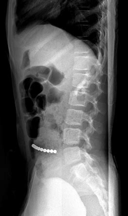 Paediatric Abdomen Lateral Decubitus View Radiology Reference