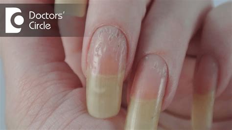 Alopecia Ridged Nails Nail Ftempo