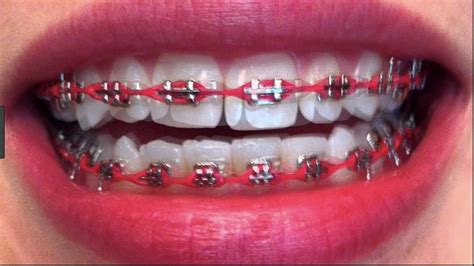 Youtube How To Put Wax On Braces Getting Your Braces Put