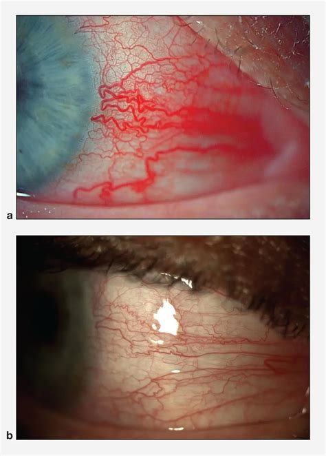 Scleritis And Episcleritis American Academy Of Ophthalmology