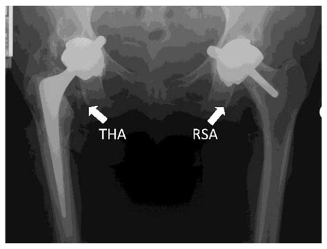 X Ray Showing A Total Hip Arthroplasty Tha And A Resurfacing