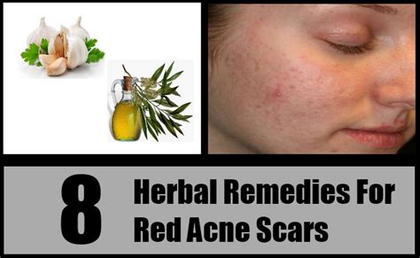8 Effective Herbal Remedies For Red Acne Scars Red Acne Treatments