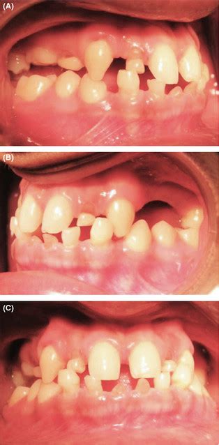 Intraoral Occlusion A Left Side B Right Side C Anterior