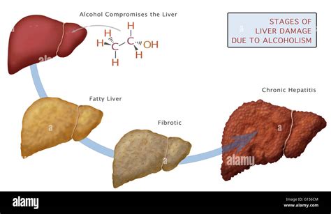 Stages Of Liver Damage Due To Alcoholism First Alcohol Compromises Stock Photo Alamy