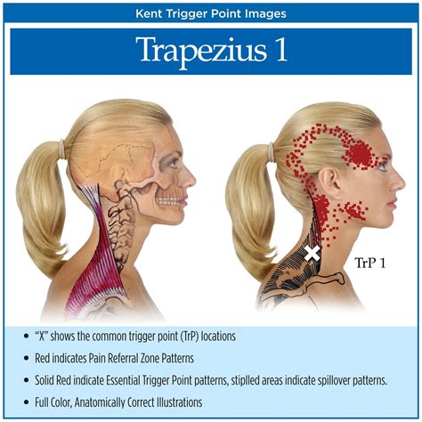 Trapezius Muscle Headache Headache