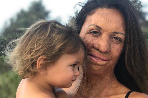 Turia Pitt Story As Fires Approached She Was Brought Back To