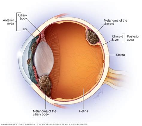 Eye Melanoma Disease Reference Guide