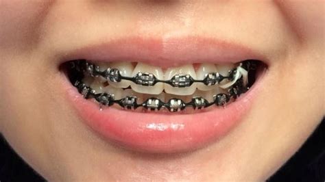 Image Result Black Braces Braces Bands Black Braces Teeth