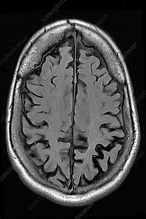 Cerebral Atrophy Mri Stock Image C0448795 Science Photo Library