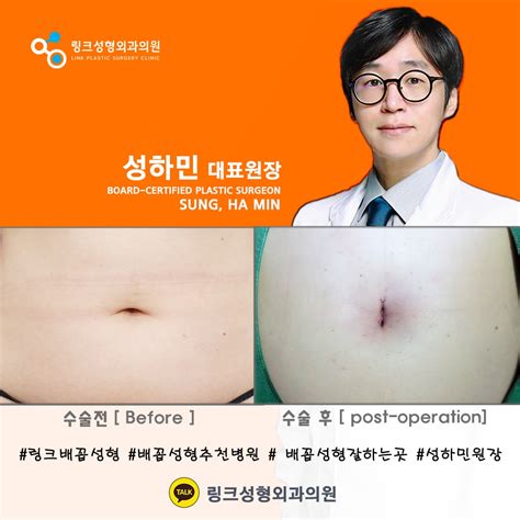 Korean Plastic Surgery Link Plastic Surgery Belly Button Reshaping
