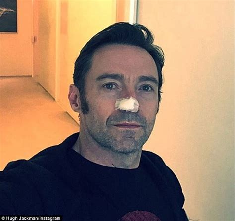 Hugh Jackman Has A 6th Skin Cancer Cut Out From His Nose Daily Mail