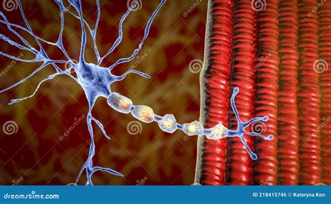 Demyelination Of A Neuron The Damage Of The Neuron Myelin Sheath Seen