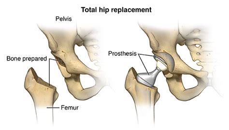 Hip Replacement Surgery Health Encyclopedia University Of Rochester