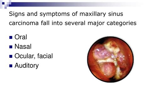 Nasal Sinus Cancer Symptoms
