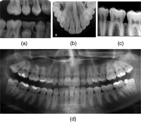 Dental Radiographs A Bitewing B Periapical C Occlusal D